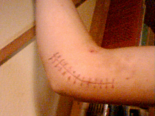 cicatrice de yannick en skate